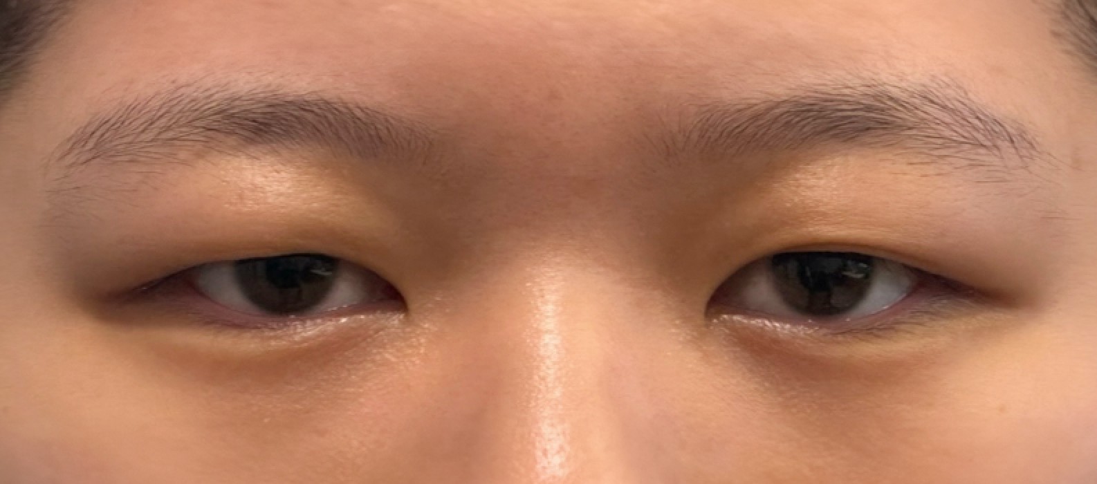 VA Plastic Surgery before photo 5
