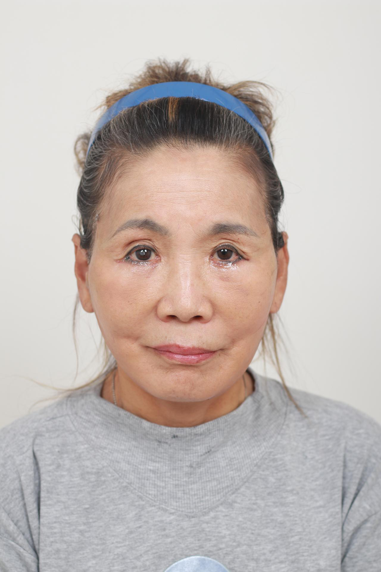 Synergy Plastic Surgery after photo 1