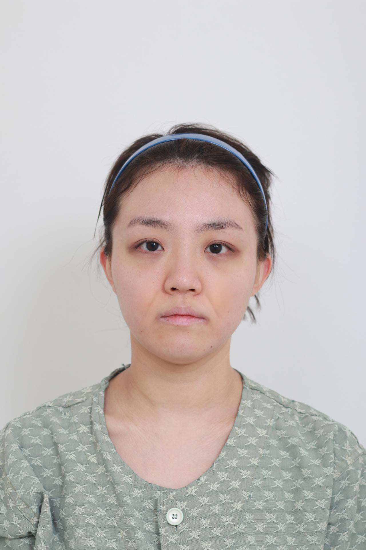 Synergy Plastic Surgery before photo 2