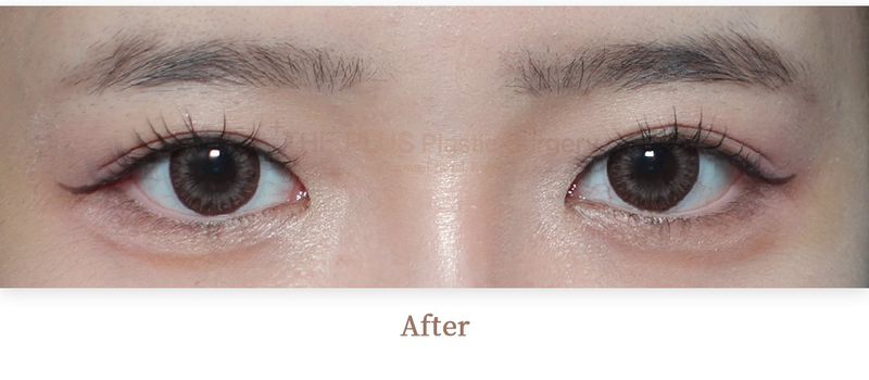 The Plus Plastic Surgery after photo 1