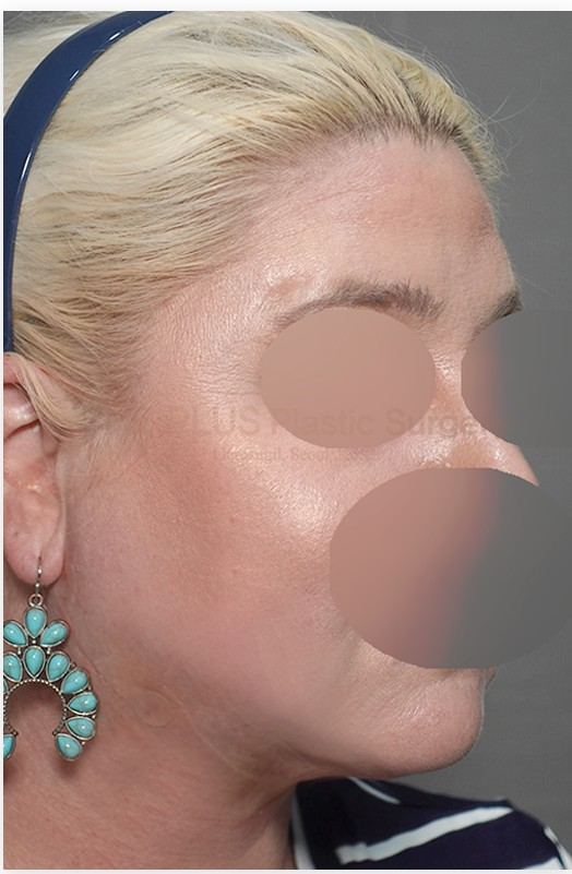 The Plus Plastic Surgery after photo 4