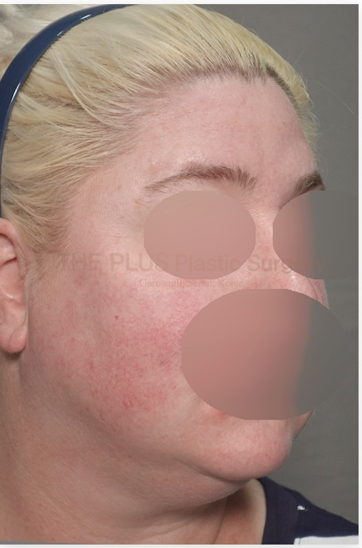 The Plus Plastic Surgery before photo 4
