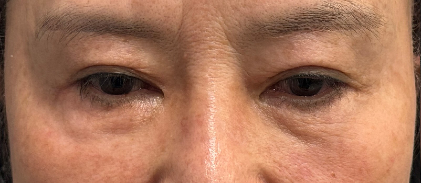 VA Plastic Surgery before photo 4