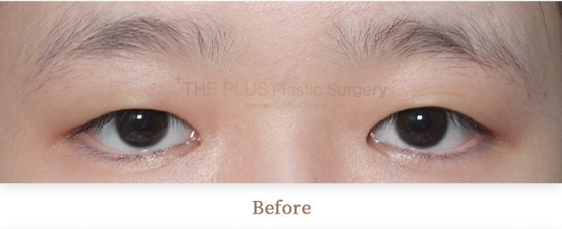The Plus Plastic Surgery before photo 1